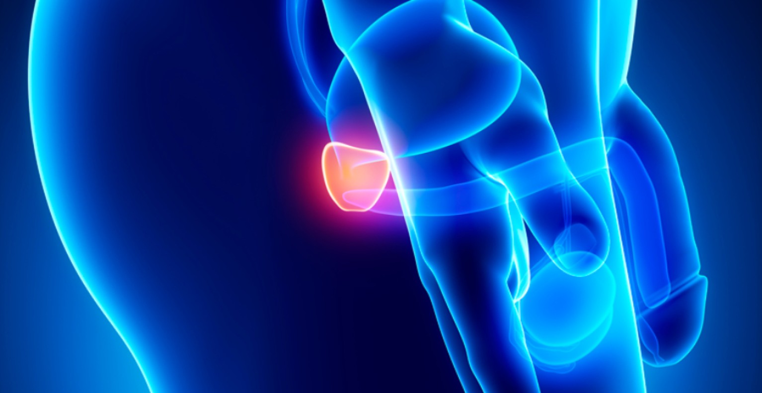 Baixos níveis de vitamina D podem estar associados com câncer de próstata agressivo